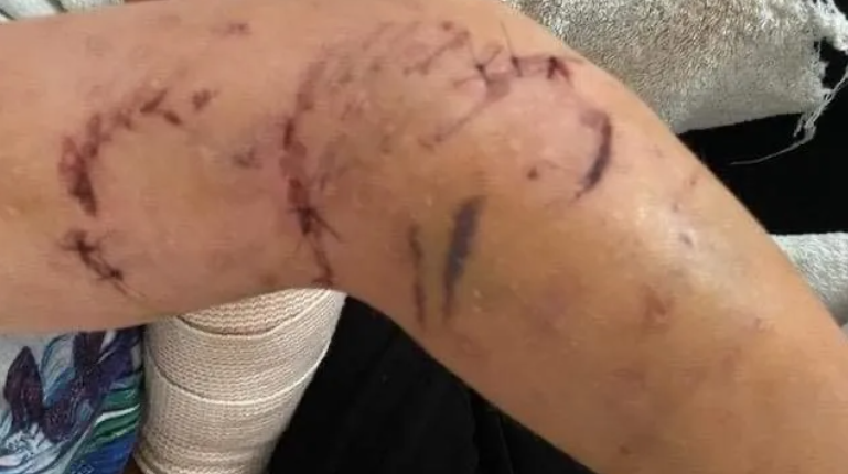 dog bite arm